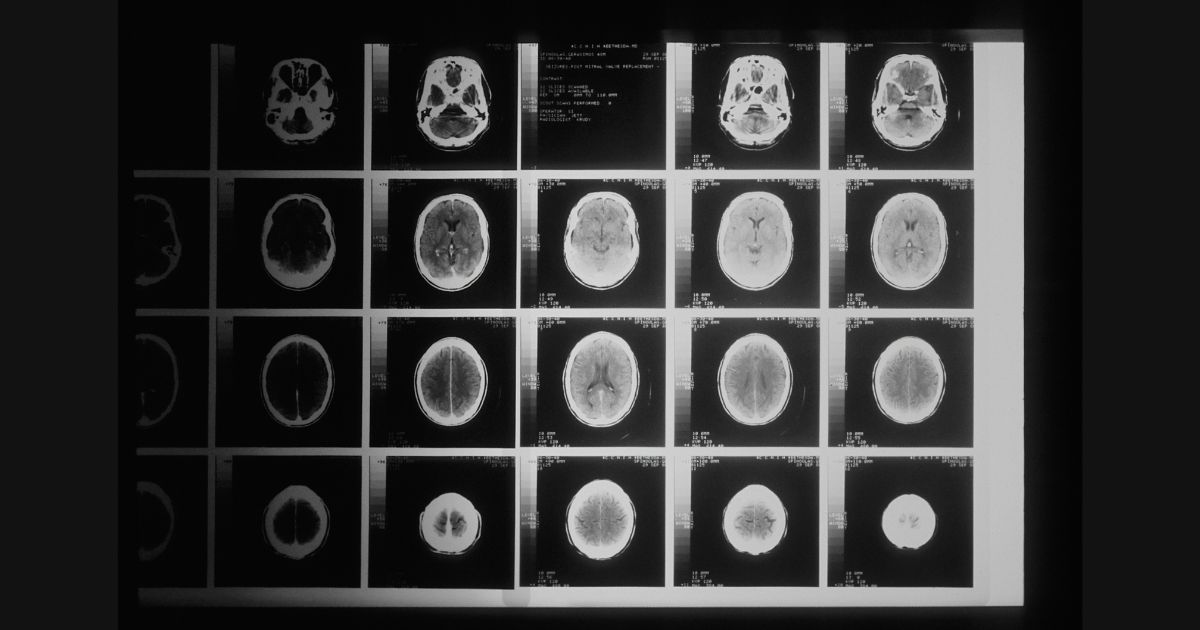 Alzheimer’s Drugs Under Fire: New Report Says Benefits May Be Minimal